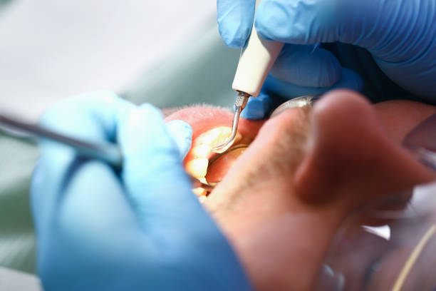 Best Chipped Tooth Repair Near Me  in Spring Valley, IL